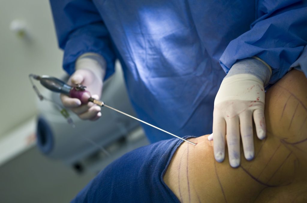 Liposuction
