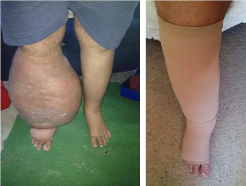 Lymphoedema Leg Decongestive Lymphatic Therapy